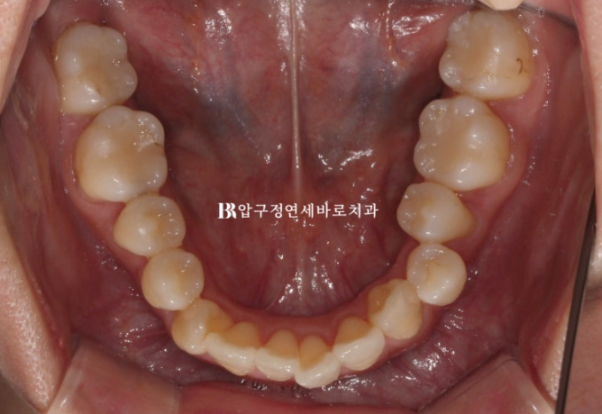 예비신부 교정 단기 앞니 부분교정 치료기간 6개월 관련 이미지 7