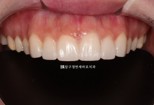 Before and After Non-Prep Veneers: Improving Gaps Between the Front Teeth and the Smile Line Together image 7