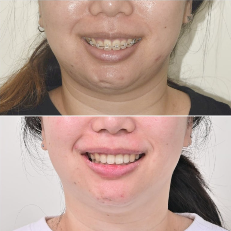 Extraction Orthodontics with Clippy-C for Protruding Mouth, Gum Smile, Gummy Smile Correction, and Treatment for a Recessed Chin image 20