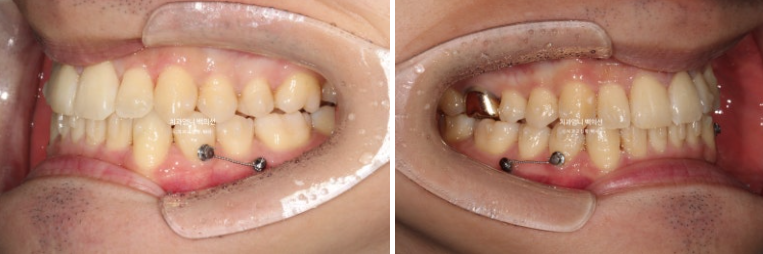 인비절라인 비발치 앞니 돌출 덧니 교정 ? 관련 이미지 8