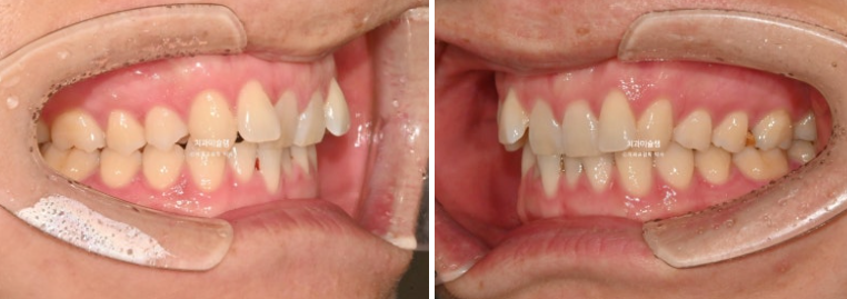 덧니 앞니 부분교정 급속교정 단기 MTA 미니튜브 기간 6개월 관련 이미지 3