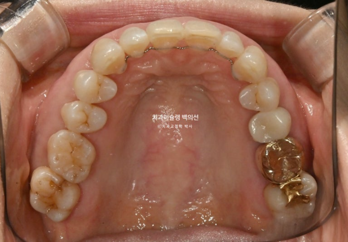 50대 치아교정 중년 발치교정 블랙트라이앵글 치료 후기 관련 이미지 14