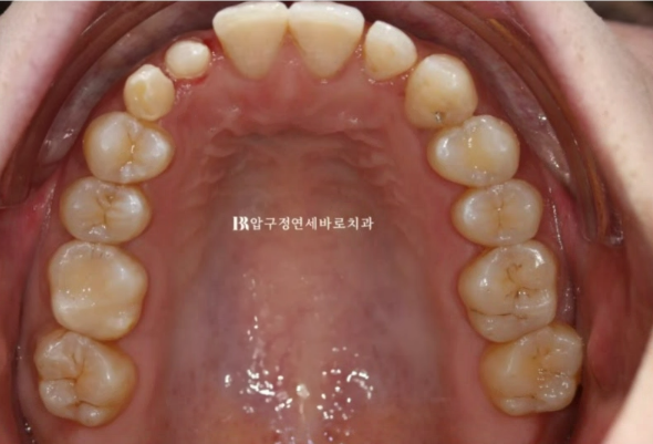 왜소치 치료 잔존유치 무삭제 라미네이트 후기 관련 이미지 5