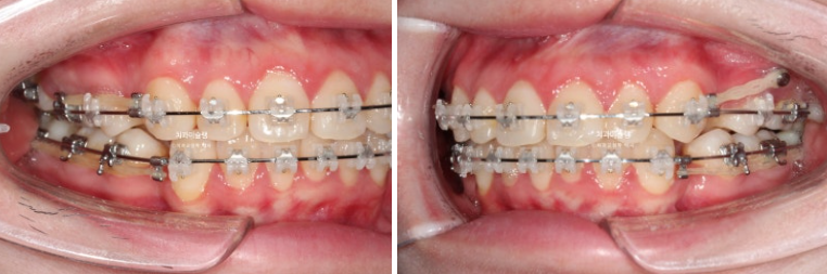 심한 돌출입 입술부전증 호두주름 발치교정 치료 관련 이미지 8