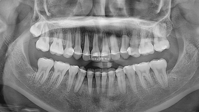 덧니 발치교정 클리피씨 입매 부작용 인중 입술 잇몸 퇴축 관련 이미지 21