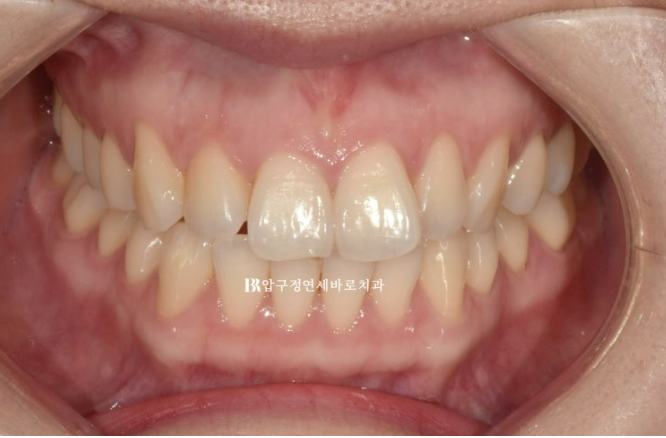 Can Rabbit Teeth Be Corrected? 5-Month Real Case of Butterfly Teeth Anterior Partial Orthodontic Treatment image 2