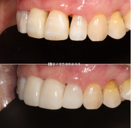 A 60s Patient’s Orthodontic Treatment Review | A Case Combining Partial Orthodontics for the Front Teeth After Periodontitis Treatment with No-Prep Veneers image 7
