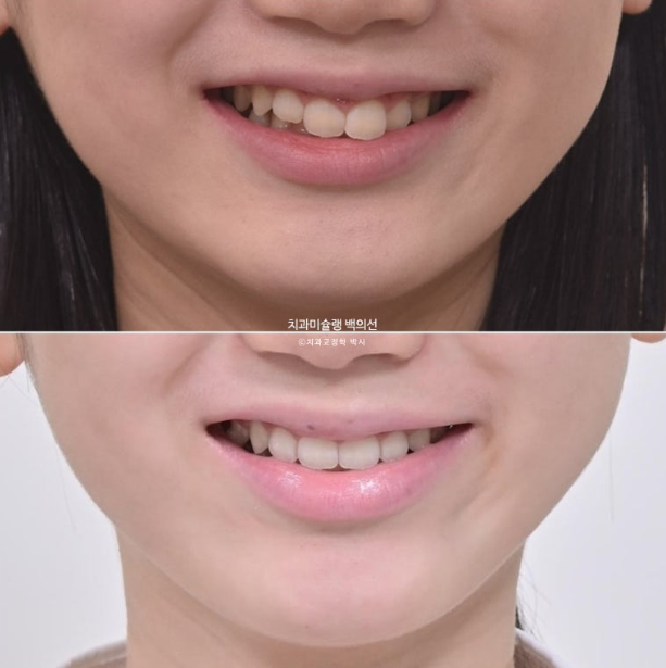 과개교합 인비절라인 모더레이트 컴프레헨시브 중심선 토끼이빨 관련 이미지 1