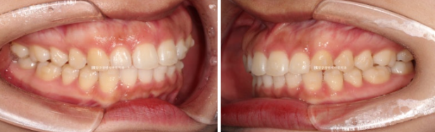 돌출입 교정 치아 벌어짐 인비절라인 투명교정 치료 관련 이미지 6