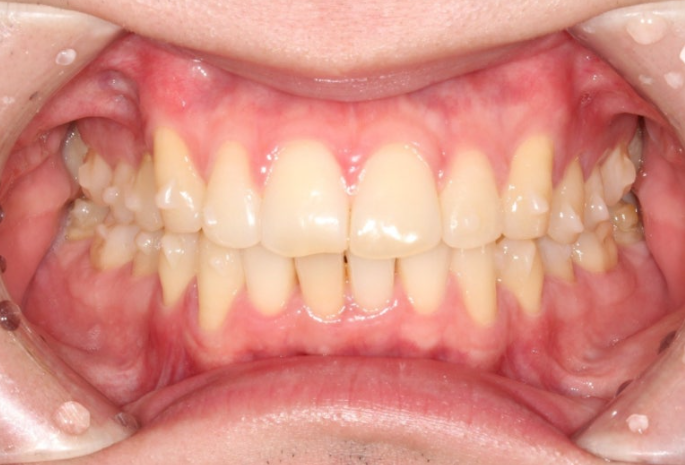 인비절라인 라이트 돌출 과개교합 중심선 교정 치간삭제 치료기간 관련 이미지 6