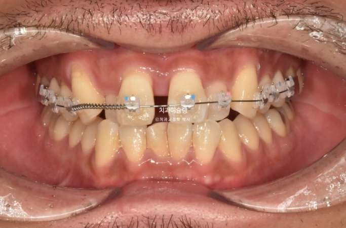 30대 MSE 악궁확장 덧니 반대교합 비발치 클리피씨 부작용 관련 이미지 9