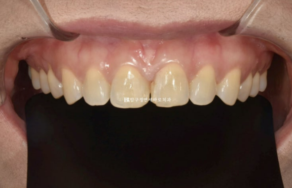 Can Gaps Between the Front Teeth Be Treated with No-Prep Veneers Alone? A Real Case Completed with Gelami After Invisalign Lite image 3