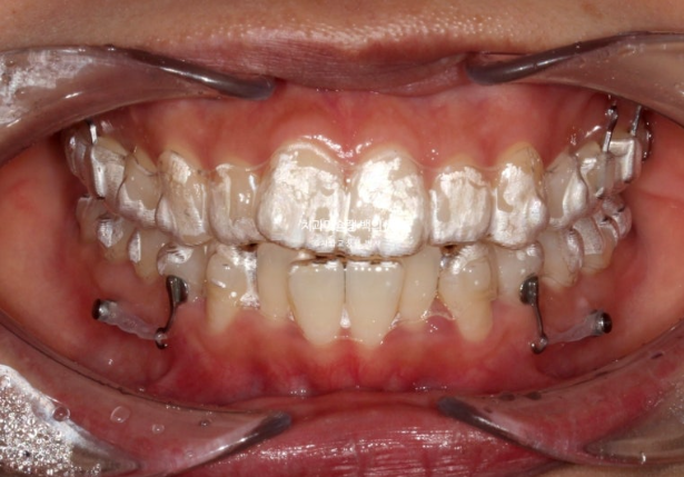 인비절라인 돌출입 발치교정 임플란트 없이 사랑니 대체 관련 이미지 8