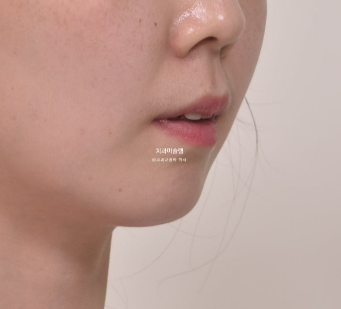 비발치 인비절라인 교정 편측 개방교합 가위교합 돌출 재교정 관련 이미지 7