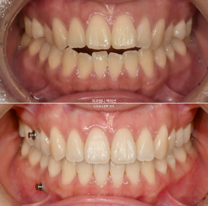 인비절라인 개방교합 교정 어금니 함입 교정 비베라? 관련 이미지 12