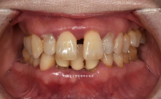 A 60s Patient’s Orthodontic Treatment Review | A Case Combining Partial Orthodontics for the Front Teeth After Periodontitis Treatment with No-Prep Veneers image 2