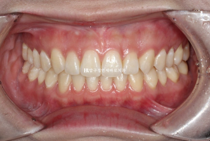 압구정 교정치과 / 옥니교정 인비절라인 라이트 덧니교정 관련 이미지 9