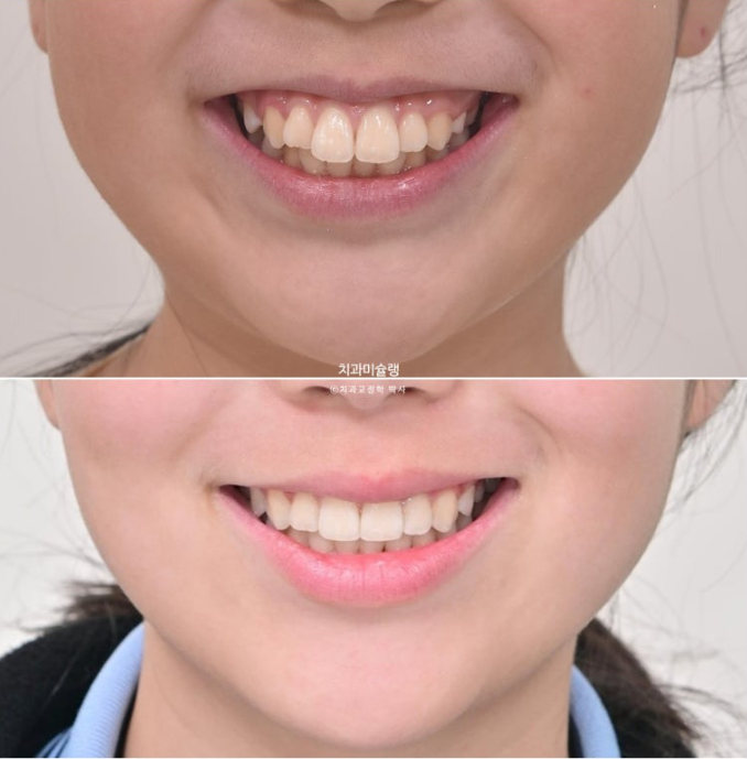 돌출입 비발치 어린이 교정 입술부전증 호두주름 호두턱 토끼이빨 인비절라인퍼스트 관련 이미지 20