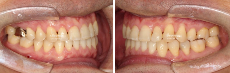 40대 인비절라인 비수술 비발치 주걱턱 비대칭 교정 관련 이미지 10