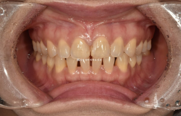 Can Gaps Between the Front Teeth Be Treated with No-Prep Veneers Alone? A Real Case Completed with Gelami After Invisalign Lite image 2