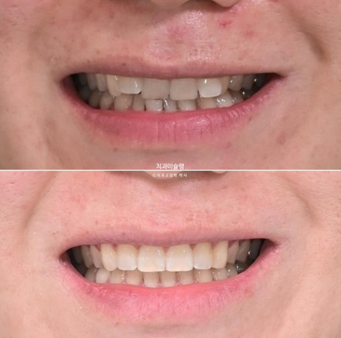 덧니 앞니 부분교정 급속교정 단기 MTA 미니튜브 기간 6개월 관련 이미지 14