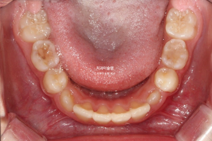 어린이 투명교정 인비절라인 퍼스트 과개교합 교정 후기 관련 이미지 17