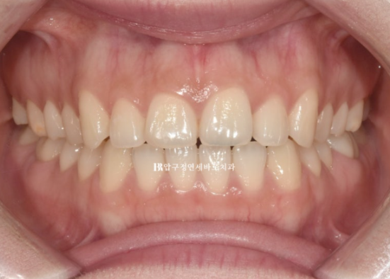 Non-Prep Veneer Review | A Case Naturally Improving Gaps Between the Front Teeth and the Smile Line image 1