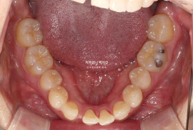 30대 교정 돌출입 교정 덧니 발치교정 치료기간 1년 8개월 관련 이미지 4