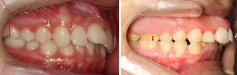 인비절라인 비추천 하는 경우? 관련 이미지 3