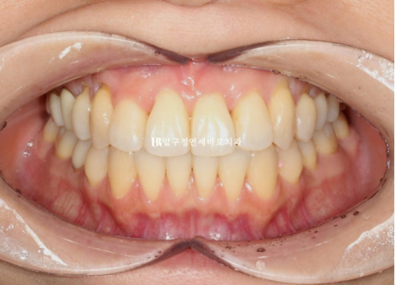 Gangnam Orthodontic Clinic: A Woman in Her 30s’ Rabbit Teeth Correction Review|Six-Month Front Teeth Partial Orthodontic Treatment That Also Improved a Crossbite image 5