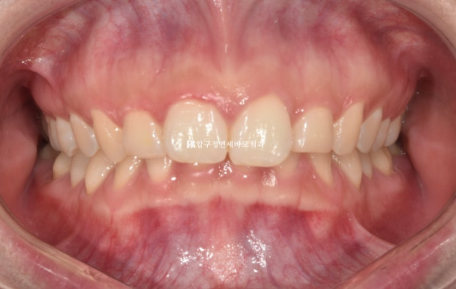 Does Invisalign Prevent Root Movement? Before-and-After Comparison of Extraction Treatment for Protruding Lips image 1