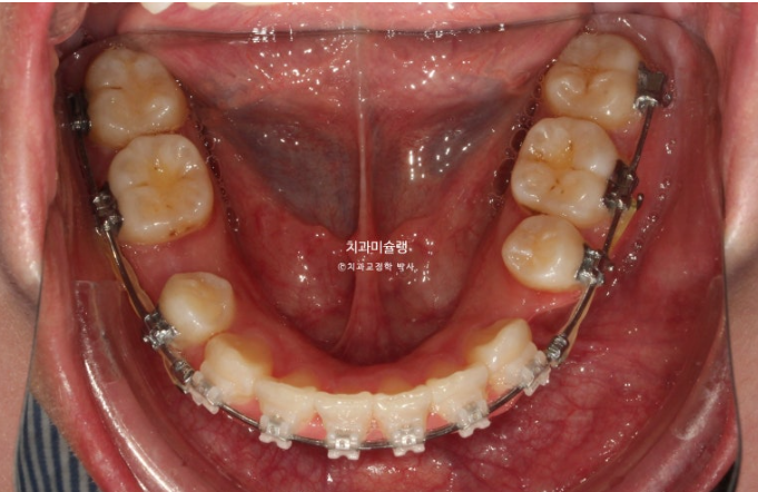 잇몸미소 거미스마일 치료 옥니 교정 잇몸성형 후기 관련 이미지 11