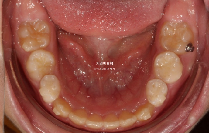 선천적 결손 잔존유치 과개교합 돌출입 인비절라인 퍼스트 어린이 투명교정 치료기간 관련 이미지 9