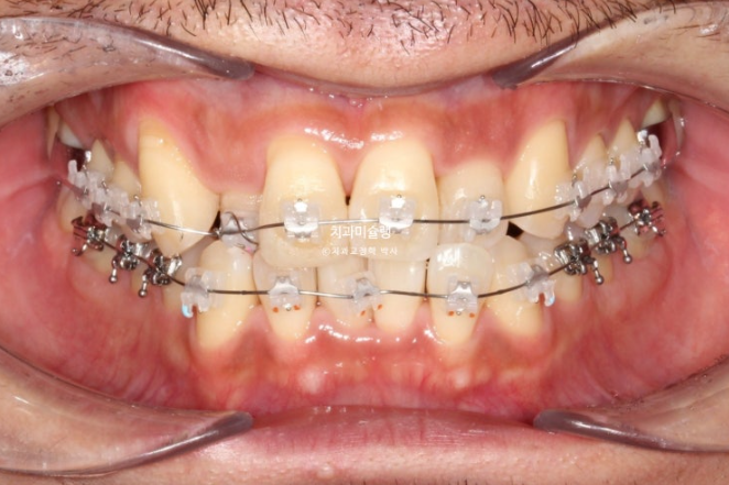 30대 MSE 악궁확장 덧니 반대교합 비발치 클리피씨 부작용 관련 이미지 10