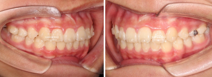 덧니 반대교합 과개교합 인비절라인 퍼스트 악궁확장 어린이 교정 관련 이미지 14