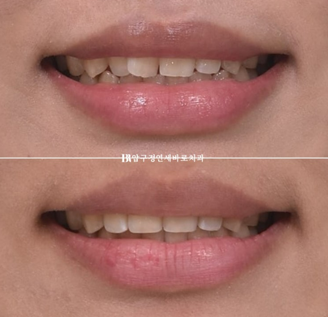 덧니도 부분교정이 가능할까요? 6개월 앞니 부분교정 실제 치료 사례 관련 이미지 12