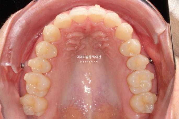 비발치 인비절라인 교정 돌출입 교정 후기 관련 이미지 12