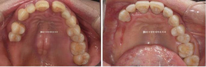 60대 치아교정 가능할까요? 치주염이 있는 경우 앞니 부분교정 6개월 치료 후기 관련 이미지 10
