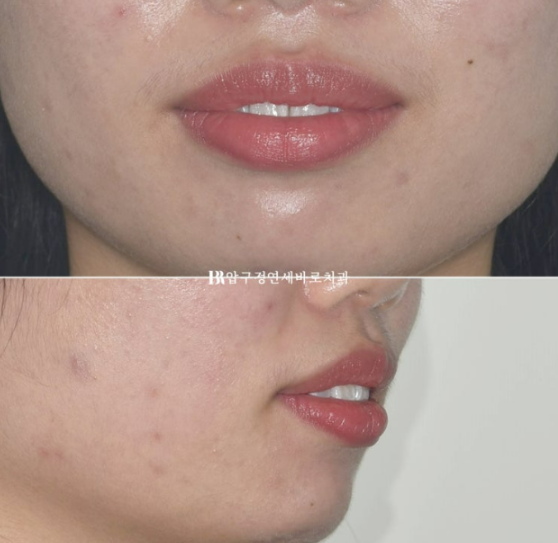 A Review of Extraction Orthodontic Treatment for Protruding Mouth | The Details of Orthodontics That Transform Buccal Corridors and Smile Lines image 3