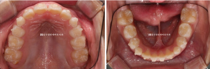 Invisalign First Correction for a Retruded Chin in a Child Orthodontic Treatment for Protrusion image 7