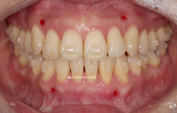 양악수술 선수술 교정 후기 인비절라인 교정 관련 이미지 6