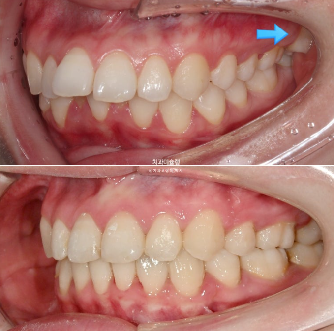 심한 돌출입 입술부전증 호두주름 발치교정 치료 관련 이미지 16