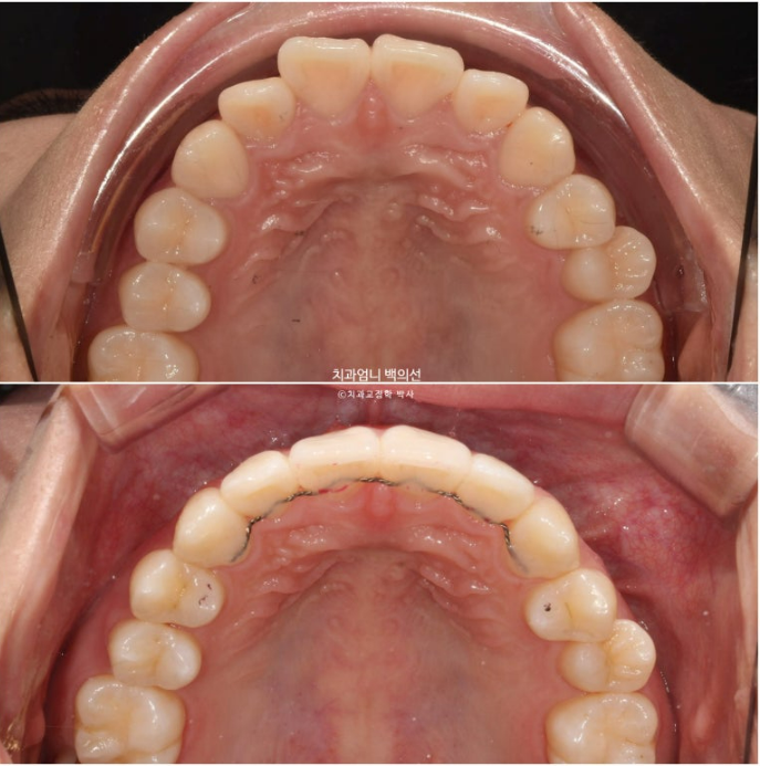 앞니 부분 교정 토끼이빨 덧니교정 ? 관련 이미지 15