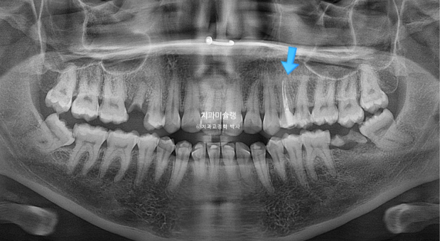 Extraction & re-orthodontics with Clippy-C, intrusion for dental implant. 관련 이미지 5