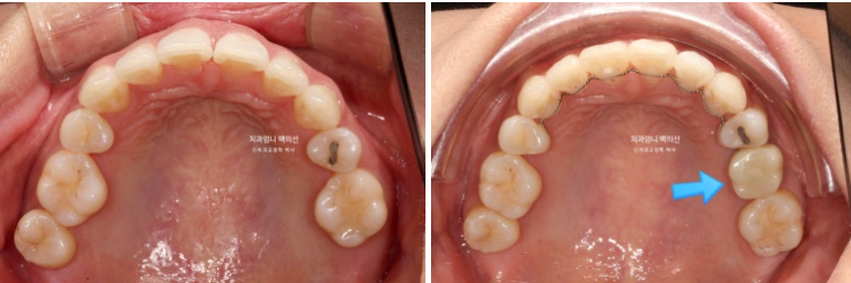 옥니 역교정 재교정 무턱 교정 치료기간 1년 10개월 관련 이미지 15