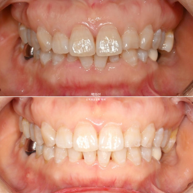 40대 인비절라인 라이트 앞니 돌출 과개교합 덧니 교정 후기 관련 이미지 15