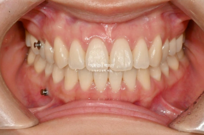 인비절라인 개방교합 교정 어금니 함입 교정 비베라? 관련 이미지 9