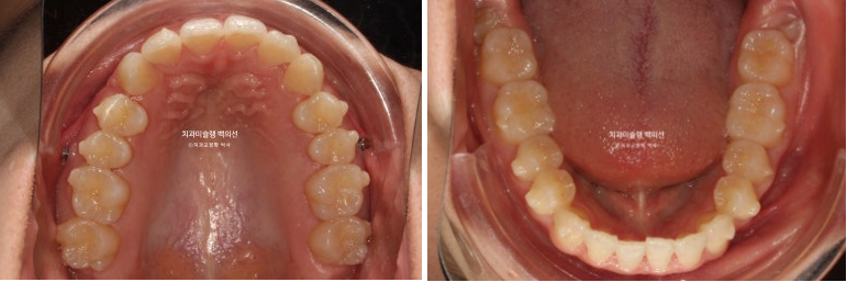 비발치 인비절라인 교정 돌출입 교정 후기 관련 이미지 9