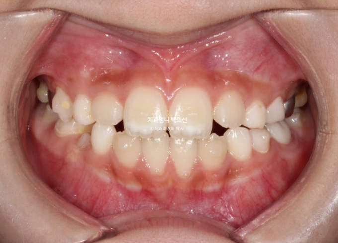 어린이 교정 인비절라인 퍼스트 비대칭 반대교합 어린이 성장 교정 관련 이미지 12