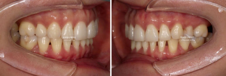 옥니 교정 역교정 재교정 무턱교정 치료기간 1년 10개월 관련 이미지 6